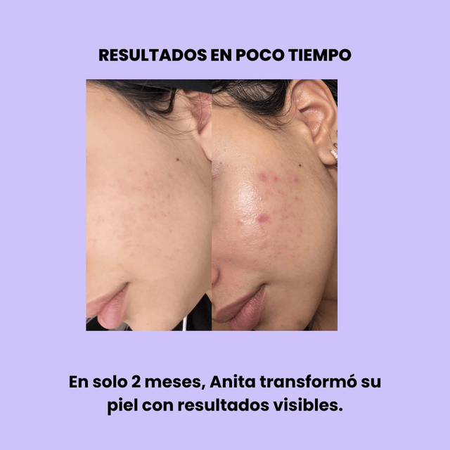 Serum con Niacinamida 10%